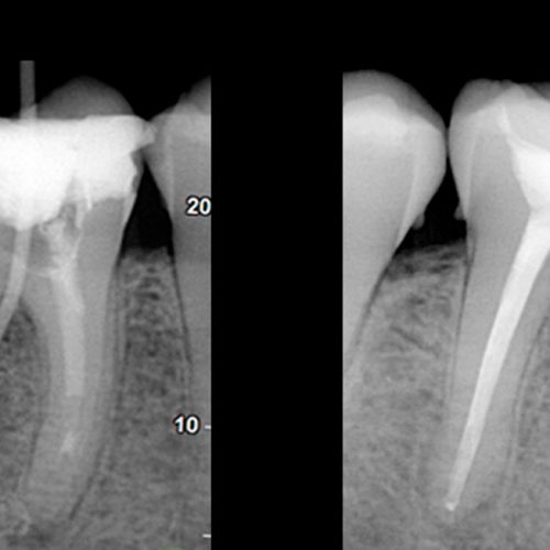 Endodoncia y Traumatismos Dentales