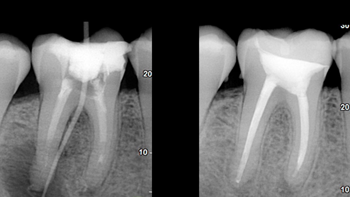 Endodoncia y Traumatismos Dentales