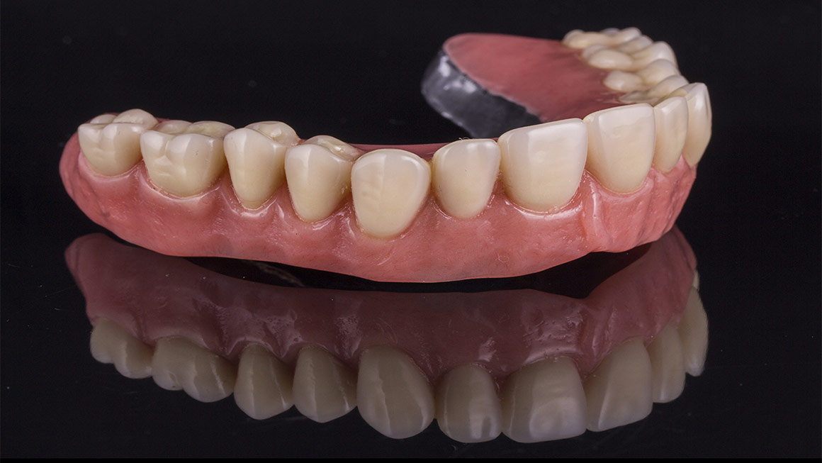 Dental prosthesis and implants
